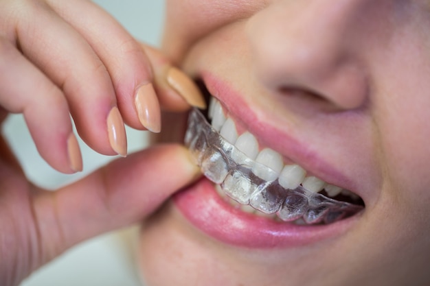 Sử dụng hàm răng giả tháo lắp trong việc tái tạo lại cấu trúc răng hư hỏng.